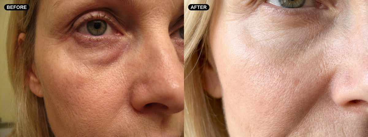 thriv-goal-undereye